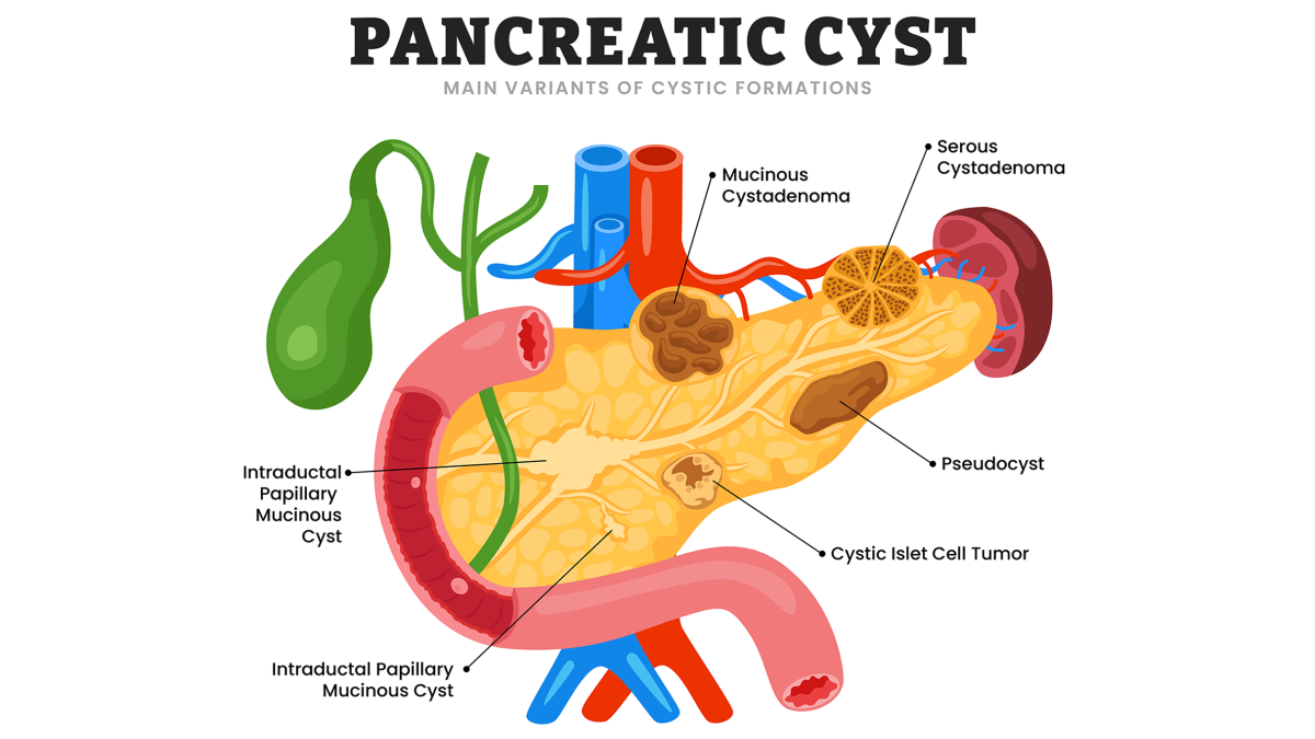 cystic tumor crossword